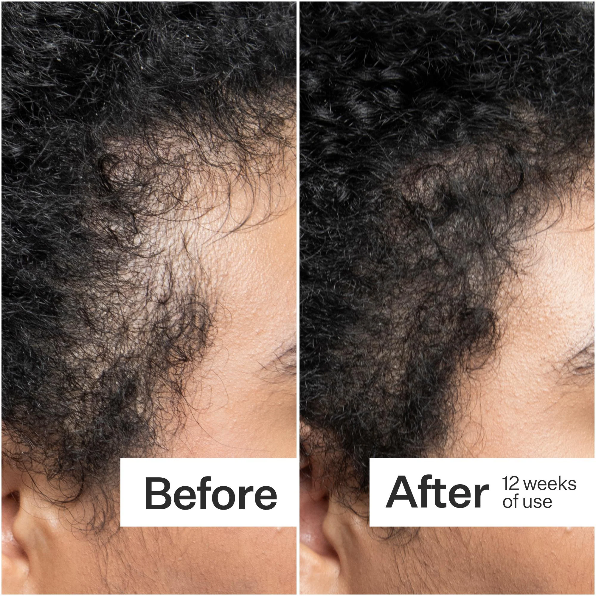 Scalp Dermastamp - Image 3
