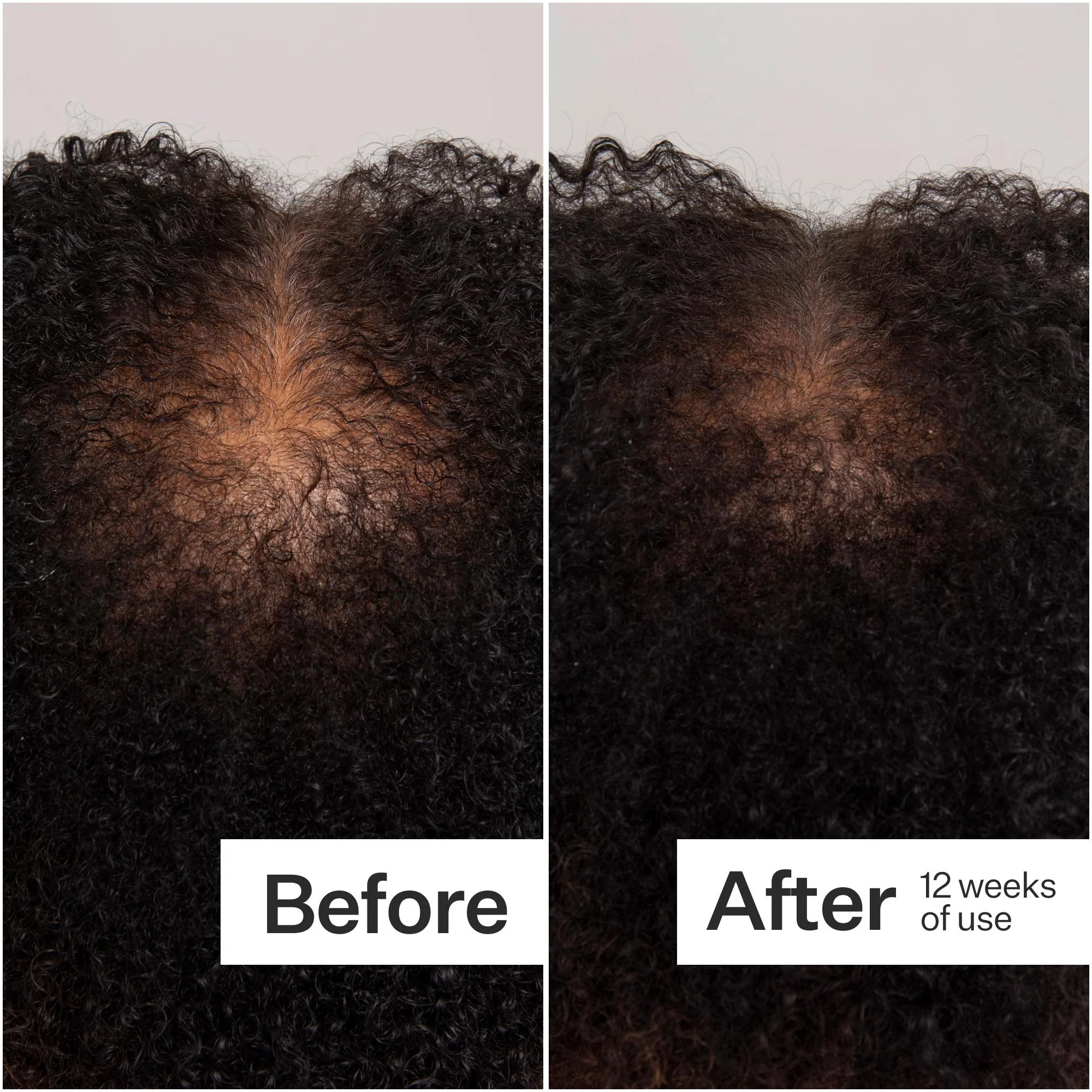 Scalp Dermastamp - Image 4