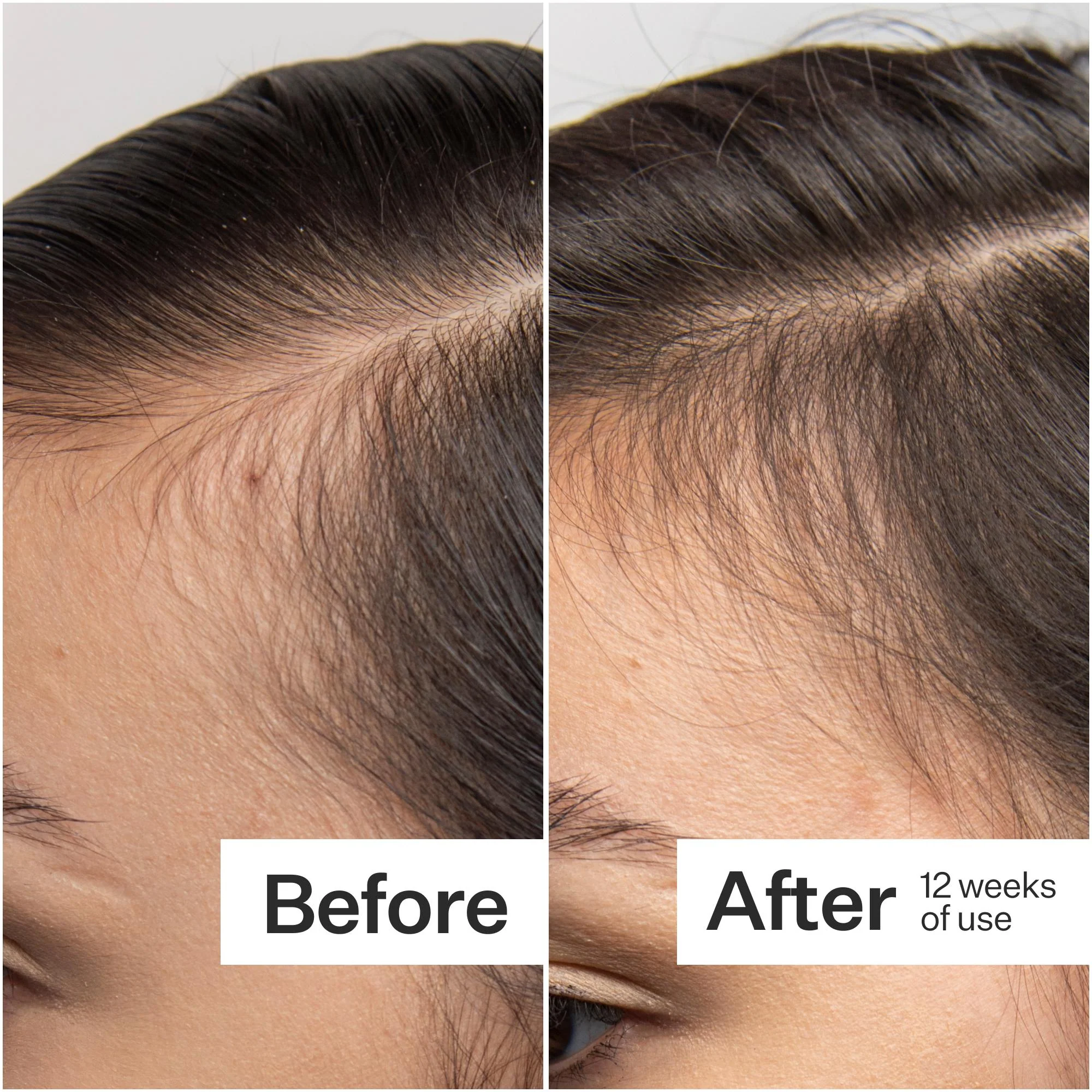 Scalp Dermastamp - Image 5