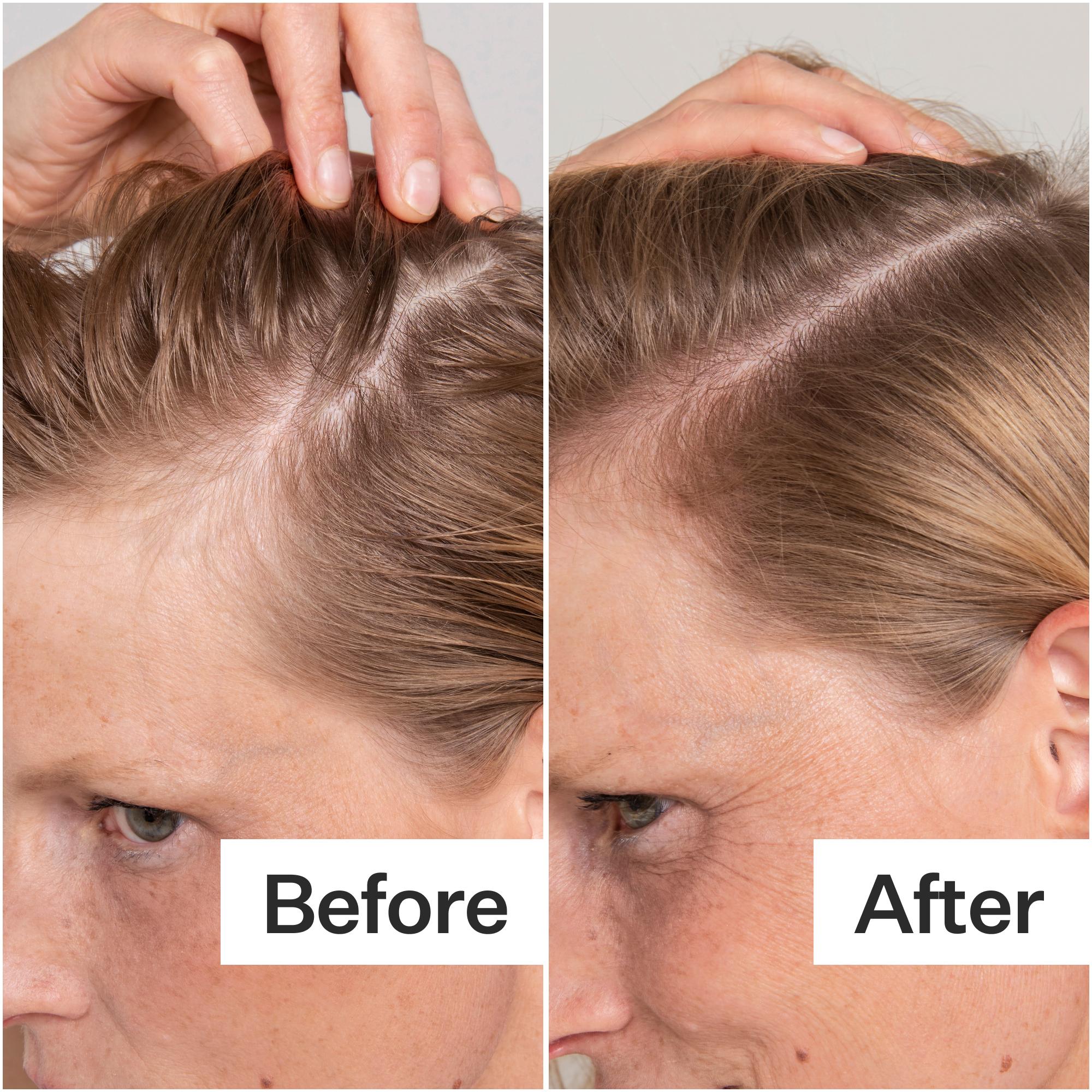 Salicylic Acid Scalp Exfoliator - Image 3
